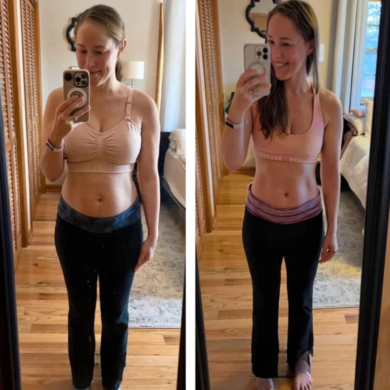 Before/after Julie B. — de-puffed belly with Lyphéa