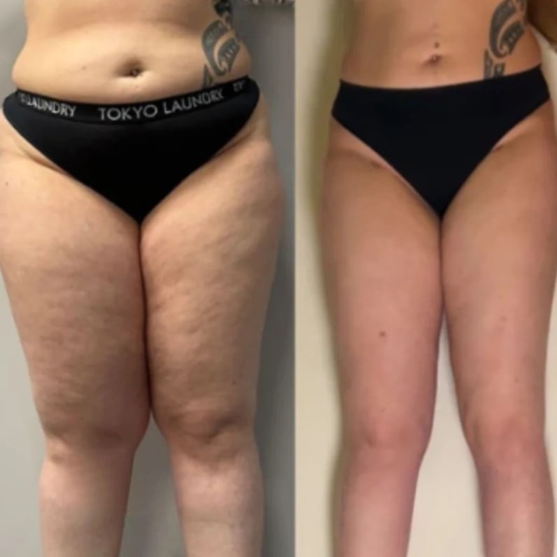 Before/after Mélanie D. — 6 weeks with Lyphéa
