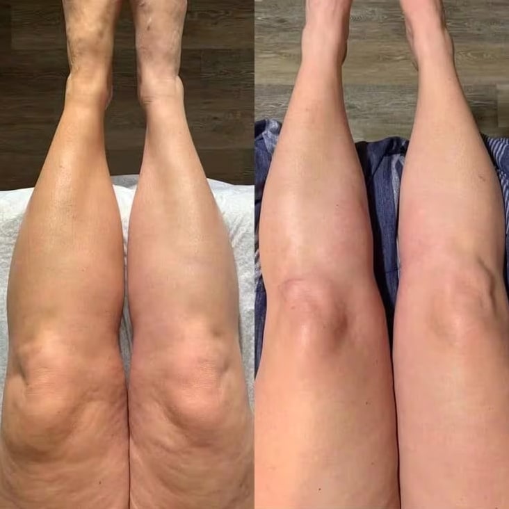 Before/after Stéphanie C. — de-puffed legs with Lyphéa